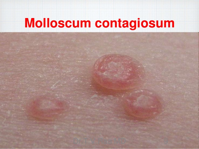 Homoeopathic Medicine for Mollascum Contagiosum