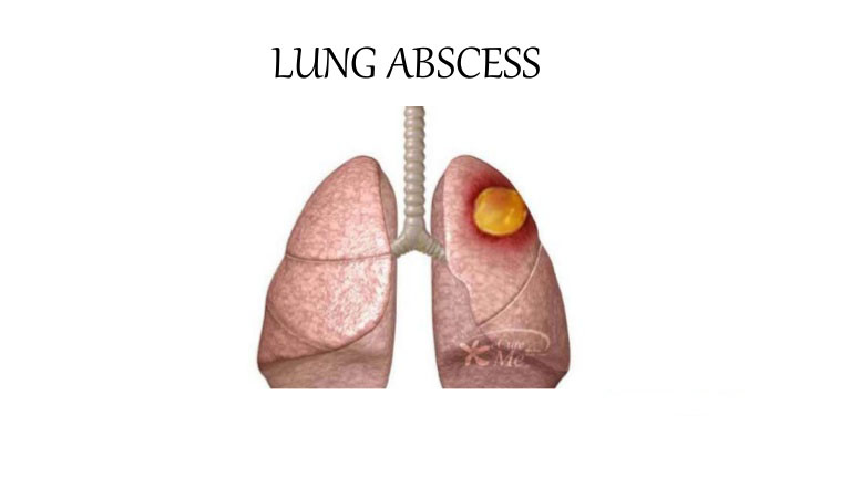 Lung abscess and its Homoeopathic Medicine