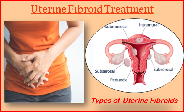 ROLE OF  HOMOEOPATHY IN  UTERINE FIBROID