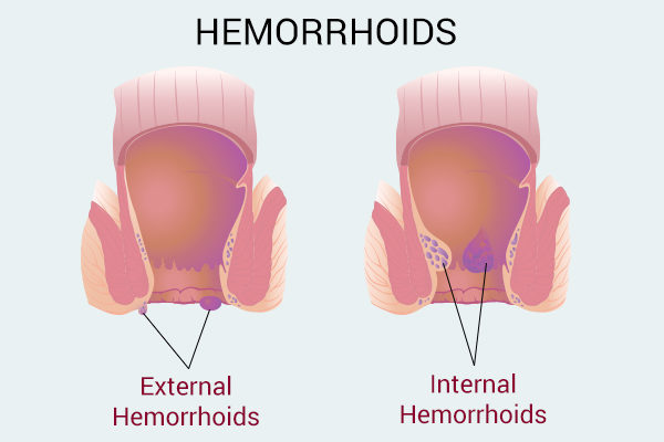 ABOUT HAEMORRHOID AND ITS HOMOEOPATHIC  REMEDIES