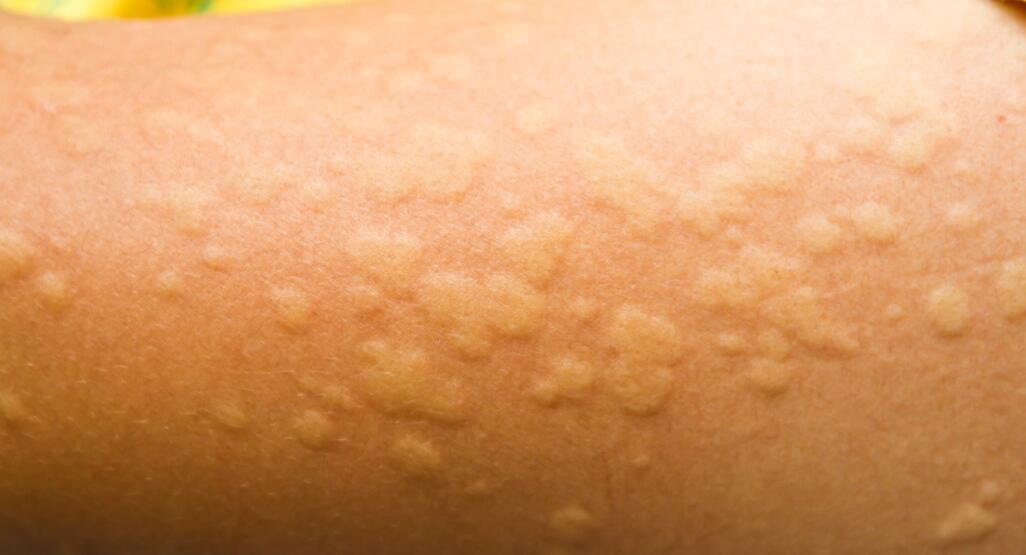URTICARIA AND ITS HOMOEOPATHIC MEDICINE