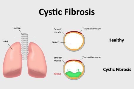 Homoeopathic Medicine For Cystic Fibrosis