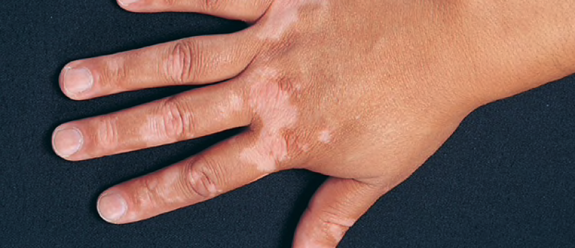 Vitiligo and its Homoeopathic Medicine