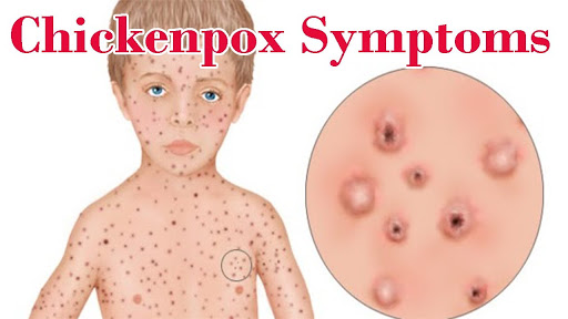 CHICKENPOX ITS CAUSES AND ITS HOMOEOPATHIC MEDICINE