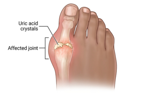 GOUT AND ITS HOMOEOPATHIC MEDICINE