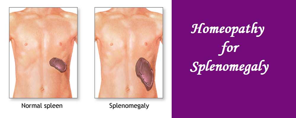 SPLENOMEGALY ITS CAUSES AND HOMOEOPATHIC REMEDIES