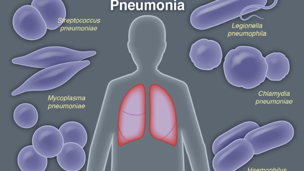About Community Acquired Pneumonia