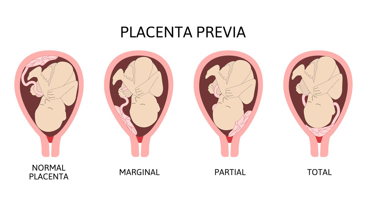 About placenta praevia
