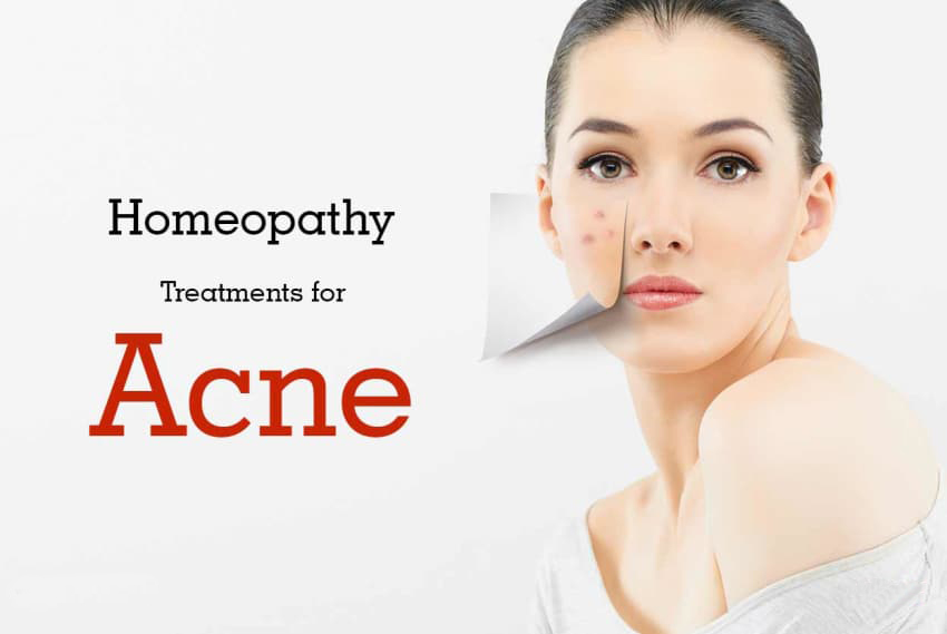 ABOUT ACNE AND ITS HOMOEOPATHIC TREATMENT