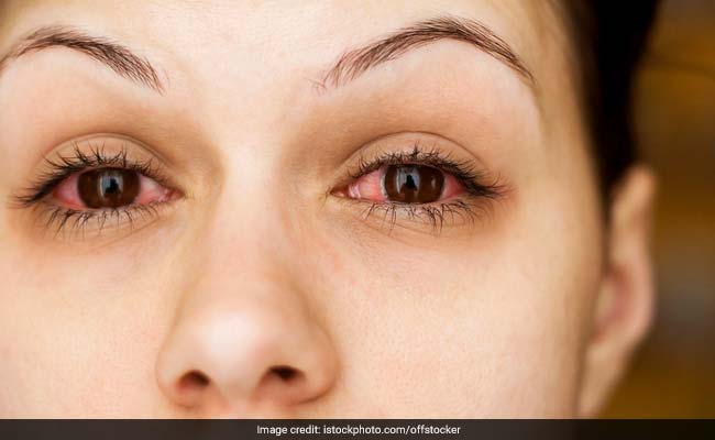 Homoeopathic Medicine For Conjunctivitis