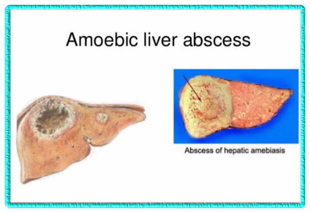 Amoebic Liver Abscess and its Homoeopathic Medicine