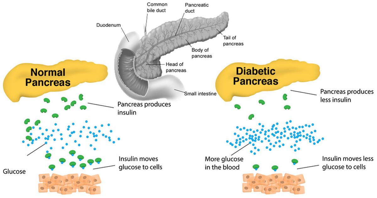 DIABETES MELLITUS ITS TYPE AND ITS HOMOEOPATHIC MEDICINE