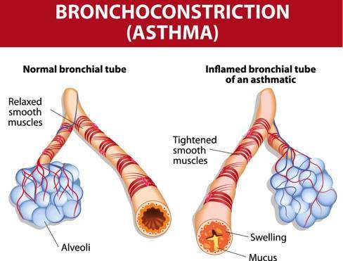 Homoeopathic Medicine For Bronchial Asthma 