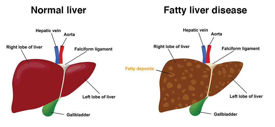 Homoeopathic Medicine For Liver Disease