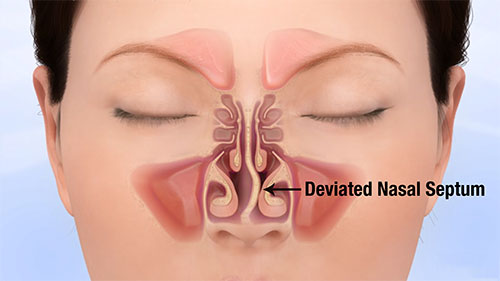 DEVIATED NASAL SEPTUM AND ITS HOMOEOPATHIC MEDICINE