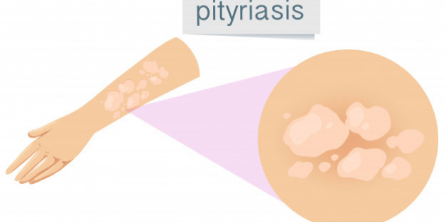 Pityriasis Alba and its Homoeopathic Medicine