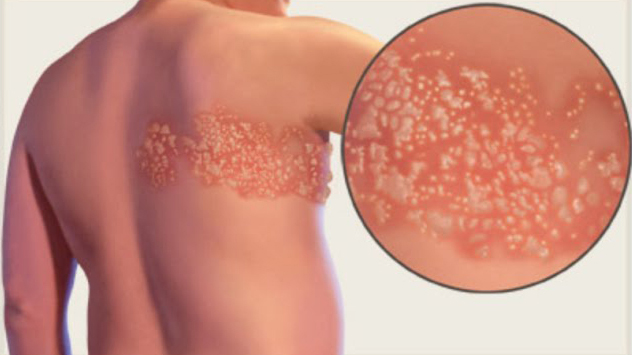 ABOUT HERPES ZOSTER SHINGLES AND ITS HOMOEOPATHIC  REMEDIES
