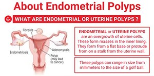 Endometrial Polyp and its Homoeopathic Medicine