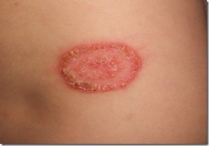 TINEA RINGWORM ITS TYPES AND HOMOEOPATHIC MEDICINE