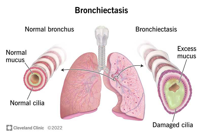 Homoeopathic Medicine For Bronchiectasis