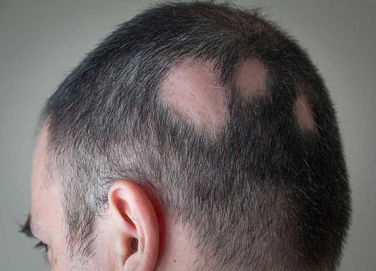 Homoeopathic Medicine for Alopecia Areata