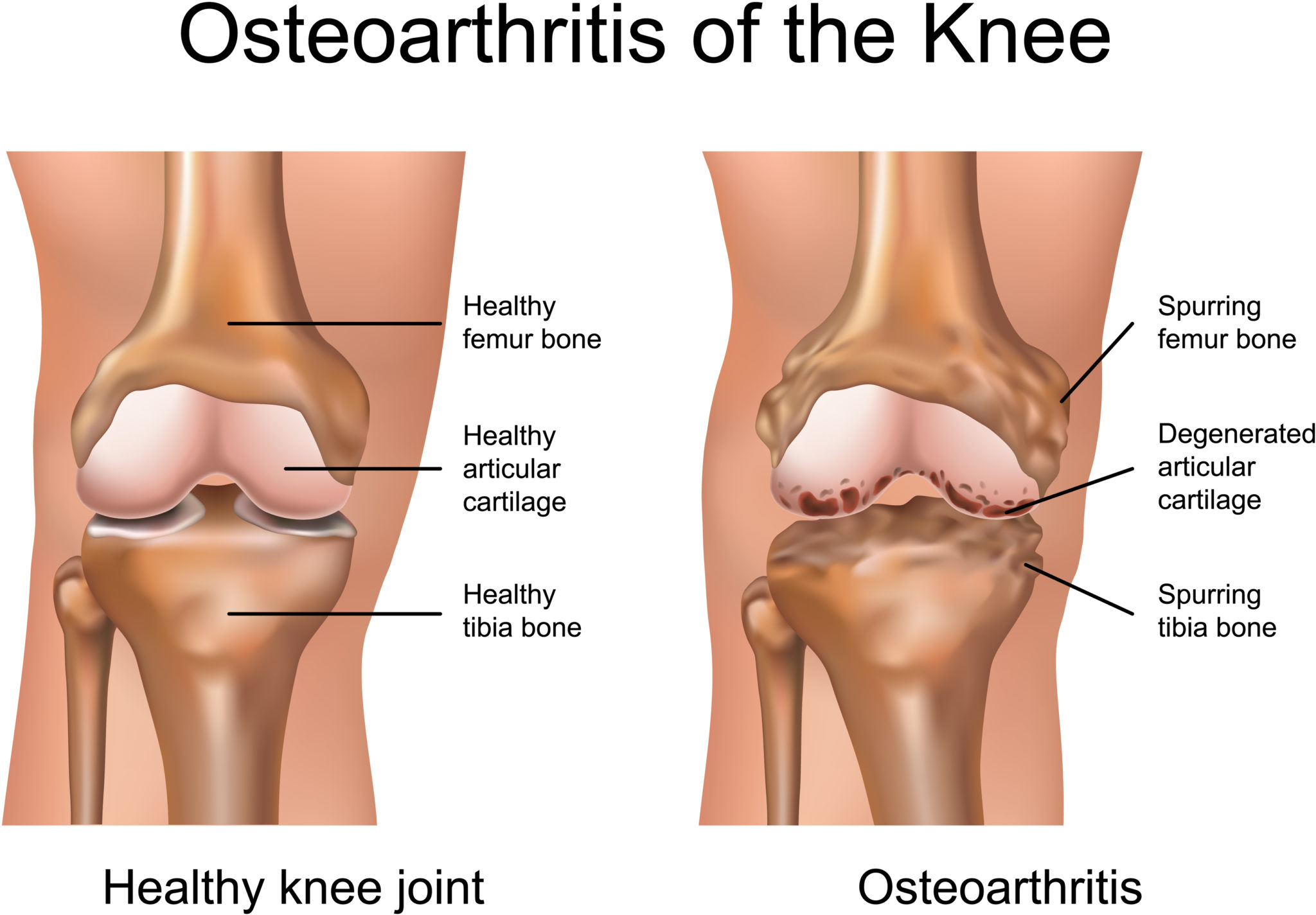 OSTEOARTHRITIS ITS CAUSES AND ITS HOMOEOPATHIC MEDICINE