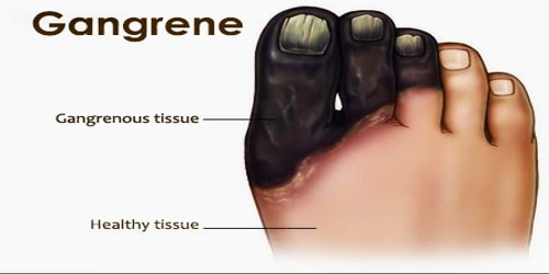Gangrene and its Homoeopathic Medicine