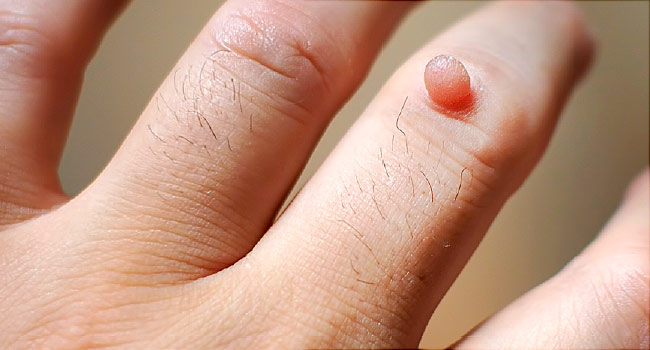 ABOUT WART AND ITS CAUSES AND HOMOEOPATHIC  REMEDIES