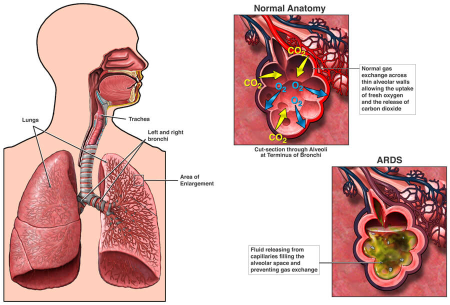 About Acute Respiratory Distress Syndrome