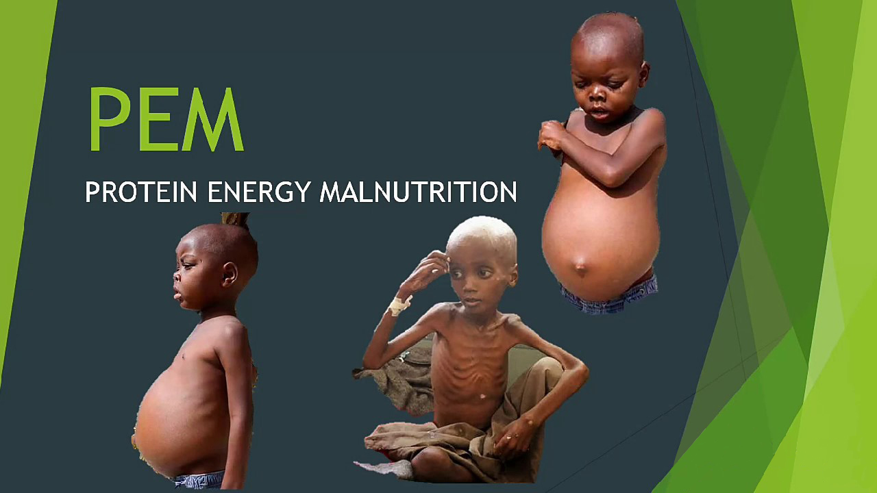PROTEIN ENERGY MALNUTRITION AND ITS HOMOEOPATHIC MEDICINE