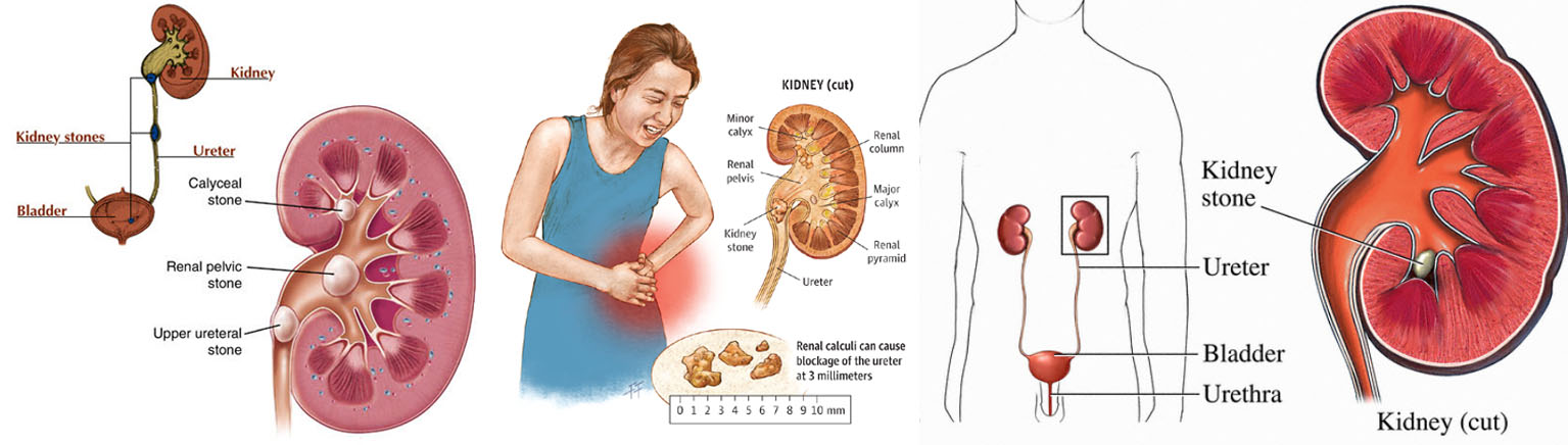 ABOUT RENAL CALCULI ITS TYPES CAUSES AND ITS HOMOEOPATHIC  REMEDIES