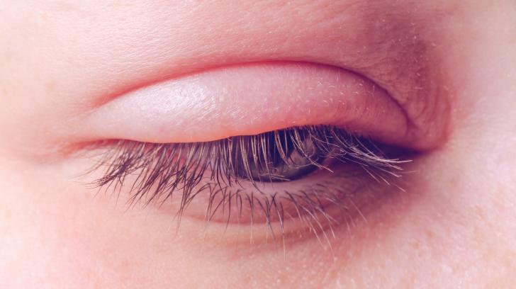 BLEPHARITIS AND ITS HOMOEOPATHIC MEDICINE