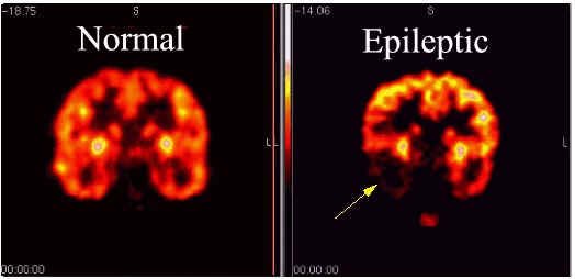 Homoeopathic Medicine For Epilepsy