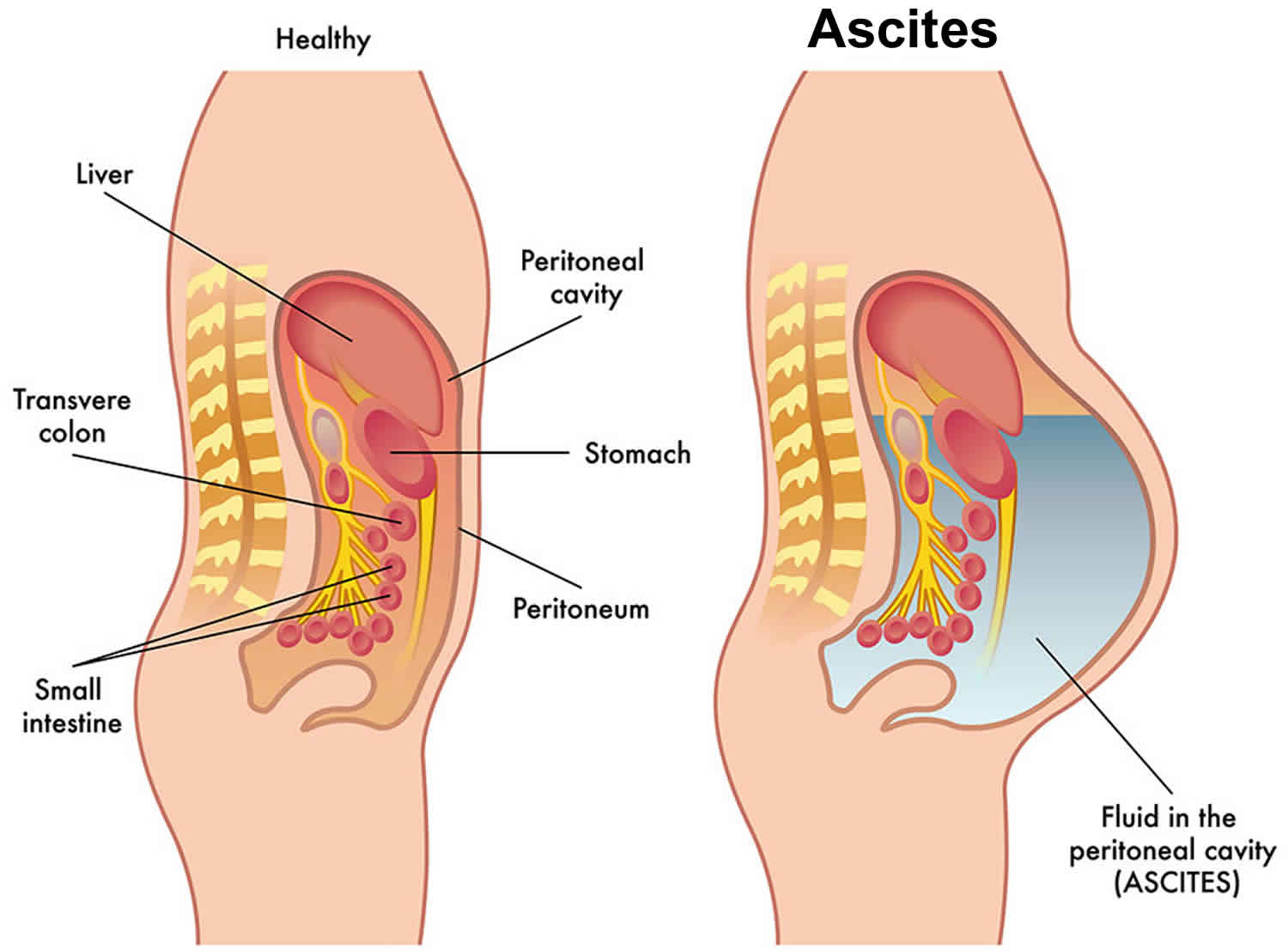 Ascites and its Homoeopathic Medicine
