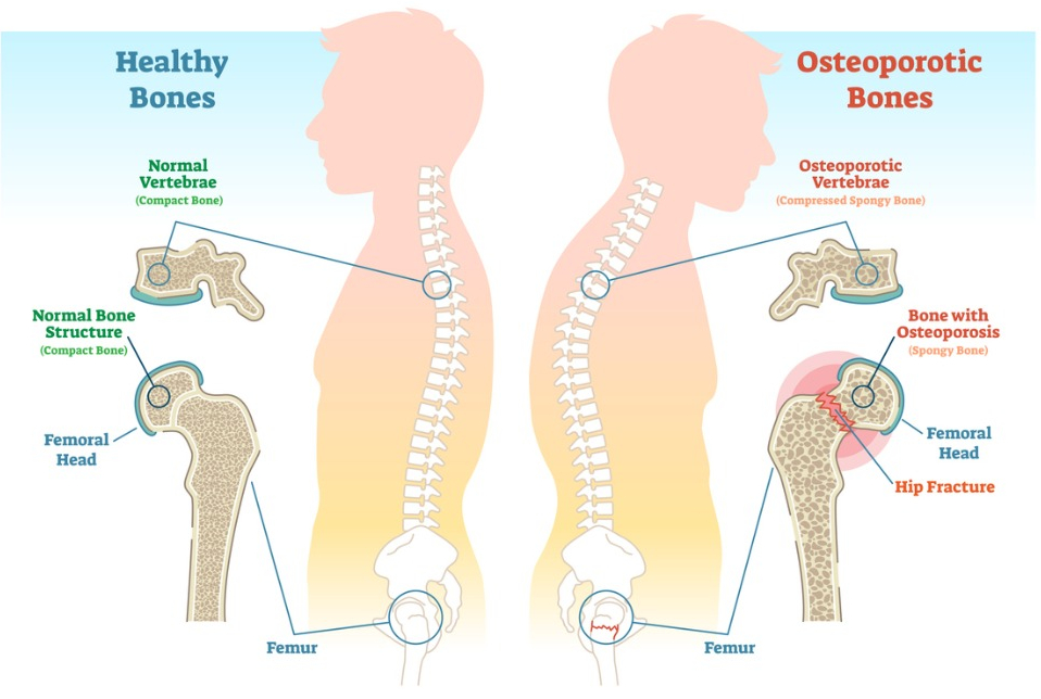Osteoporosis and its Homoeopathic Medicine