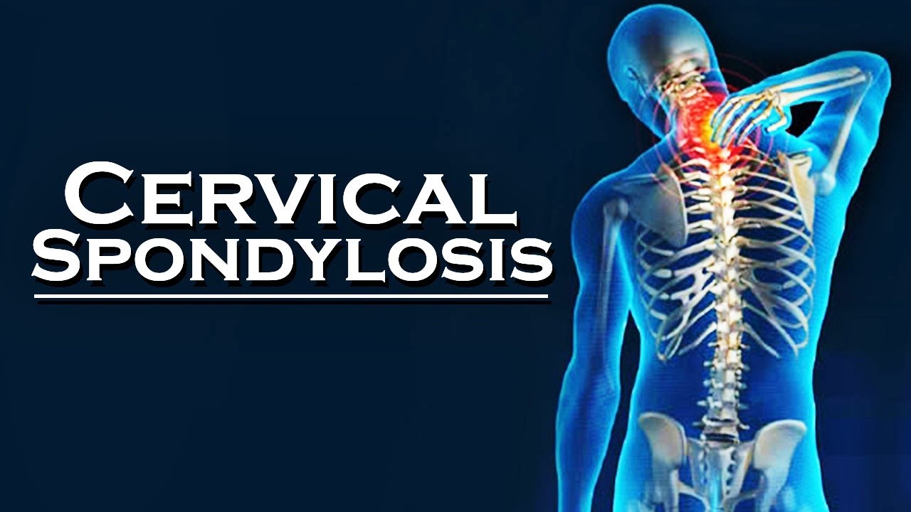ABOUT CERVICAL SPONDOLYSIS ITS CAUSES AND ITS HOMOEOPATHIC  REMEDIES