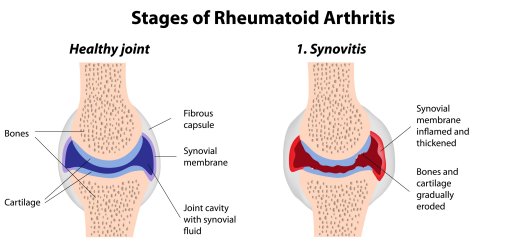 RHEUMATOID ARTHRITIS AND ITS HOMOEOPATHIC MEDICINE
