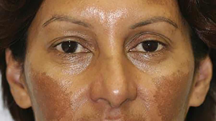 Homoeopathic Medicine For Melasma