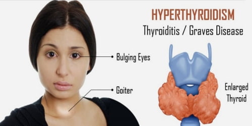 HYPERTHYROIDISM AND ITS HOMOEOPATHIC MEDICINE