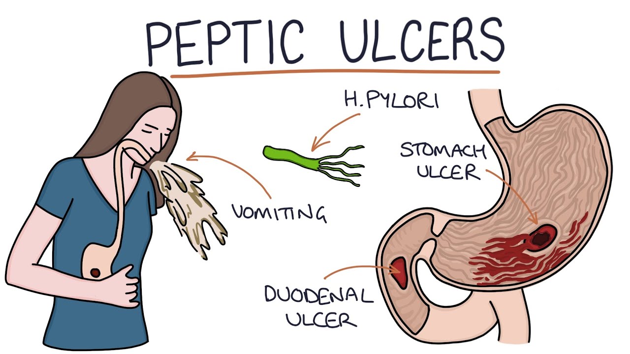 About Peptic Ulcer