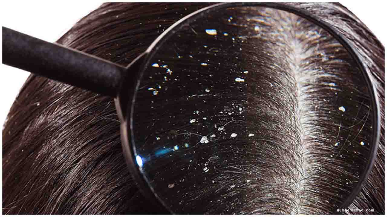 Dandruff and its Homoeopathic Medicine